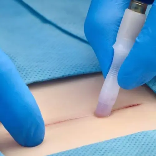 Adesivo Cirúrgico SurgiSeal Stylus 0,5ml Uso Tópico para Pele - Bioline