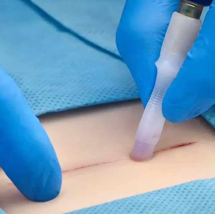 Adesivo Cirúrgico SurgiSeal Stylus 0,5ml Uso Tópico para Pele - Bioline
